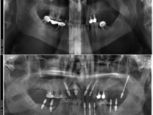 Sinus Lift Dental Implants