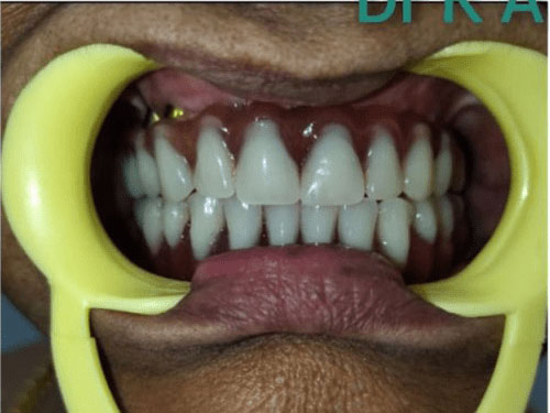 Dental Bone Graft Implants in India