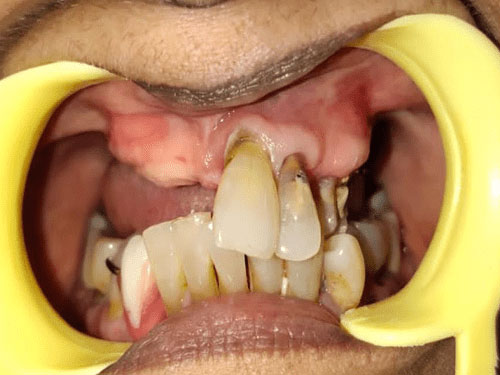 Dental Bone Graft Implants in India
