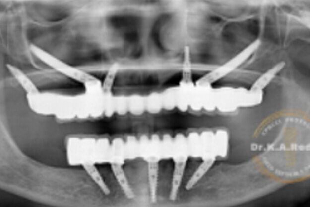 Dental Bone Graft