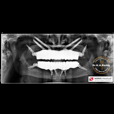 Zygomatic Implants in India for Severe Bone Loss: Graftless Full Mouth Implants with Fixed Teeth in Just 5 Days