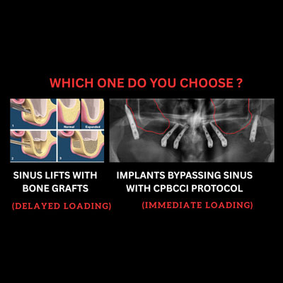 Full Mouth Dental Implants in India Without Sinus Lift: Graftless Solution for Severe Bone Loss