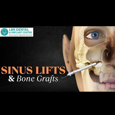 Sinus Lift with Bone Grafts vs Affordable Graftless Dental Implants: The Best Solution for Full Mouth Rehabilitation