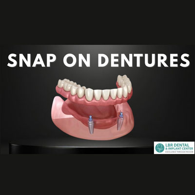 Snap on Dentures