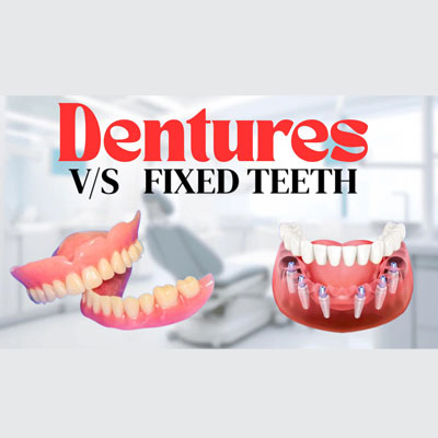 Dentures v/s Fixed Teeth on Implants