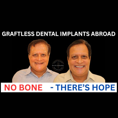 Graftless Dental Implants Abroad