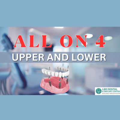 All-on-4 Upper and Lower