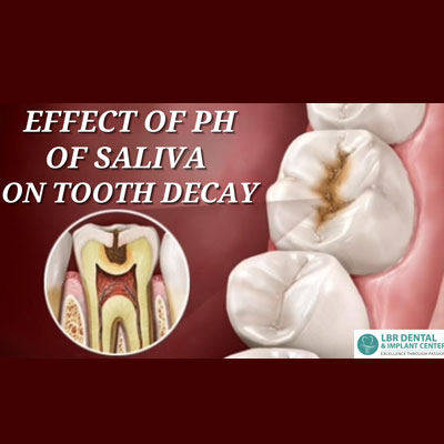 Effect of PH of Saliva on Dental Caries