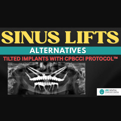 Sinus Lift Alternatives