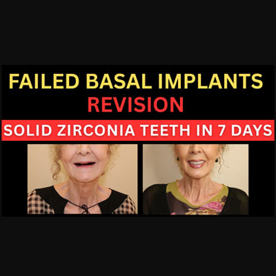 Best Clinic for Failed Basal Implant Revision in India
