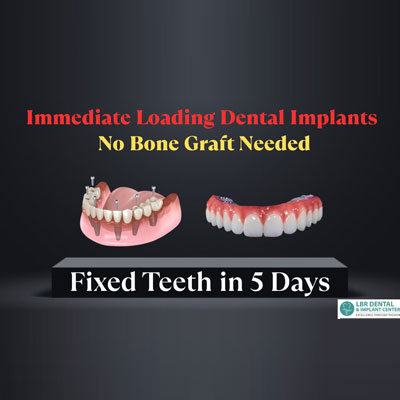 Immediate Loading Dental Implants – Fixed Teeth in 5 Days, No Bone Graft Needed