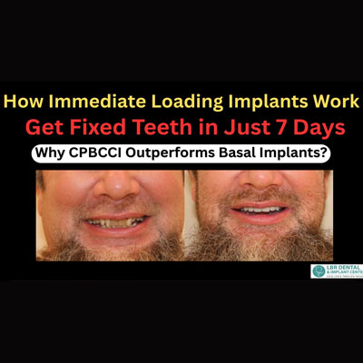 Immediate  Loading Implants Explained: Fixed Teeth Without Delay