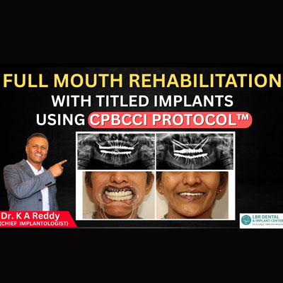 How CPBCCI Protocol Is Better Than Basal Implants for Full-Mouth Rehabilitation