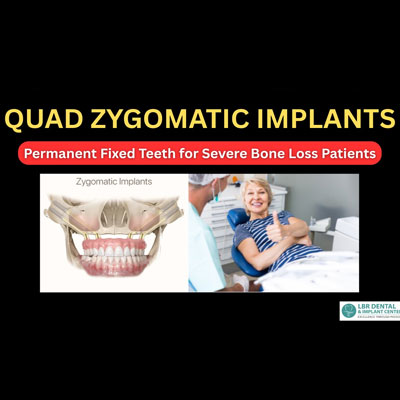 Quad Zygomatic Implants – Permanent Fixed Teeth for Severe Bone Loss Patients
