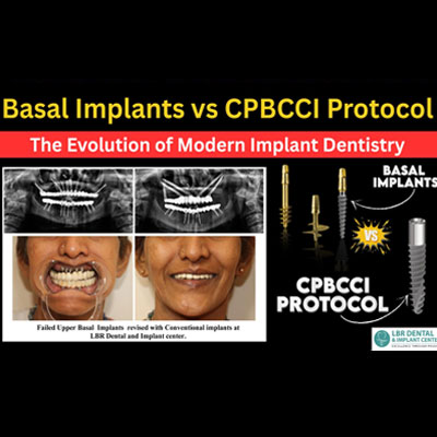 Basal Implants vs CPBCCI Protocol – The Evolution of Modern Implant Dentistry