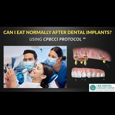 Can I Eat Normally After Dental Implants?