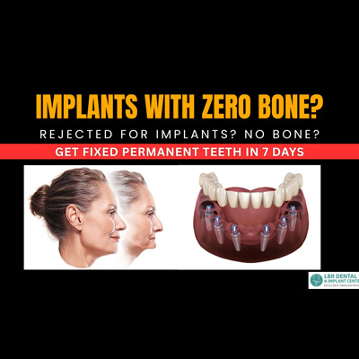 Full Mouth Dental Implants for Patients with Zero Bone: Is It Really Possible?