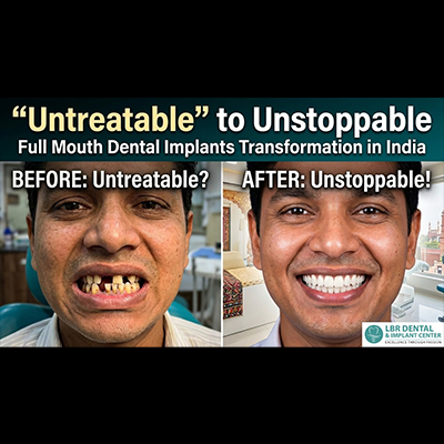 From “Untreatable” to Unstoppable:Full Mouth Dental Implants Transformation in India