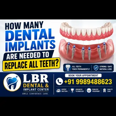 How Many Dental Implants Are Needed to Replace All Teeth?