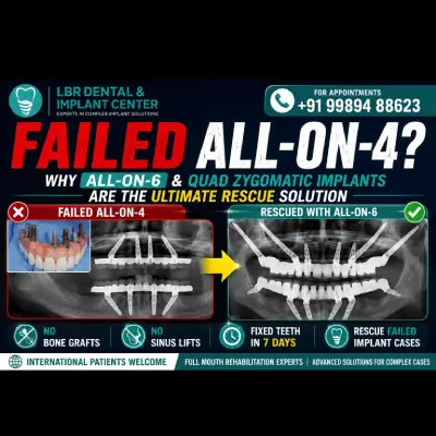 Failed All-on-4 Implants?