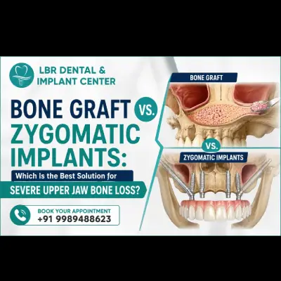 Bone Graft vs. Zygomatic Implants: Which Is the Best Solution for Severe Upper Jaw Bone Loss?