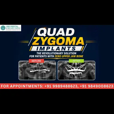 Quad Zygoma Implants