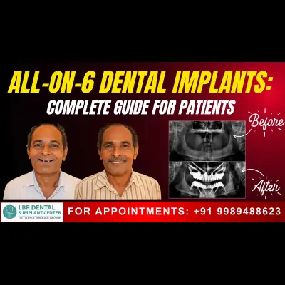 All-on-6 Dental Implants: Complete Guide for Patients