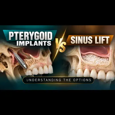 Pterygoid Implants vs Sinus Lift: Understanding the Options